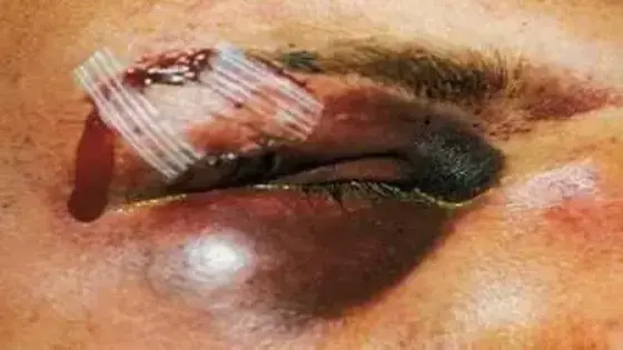 جناة يفقأون عين شخص بدافع السرقة في تزنيت