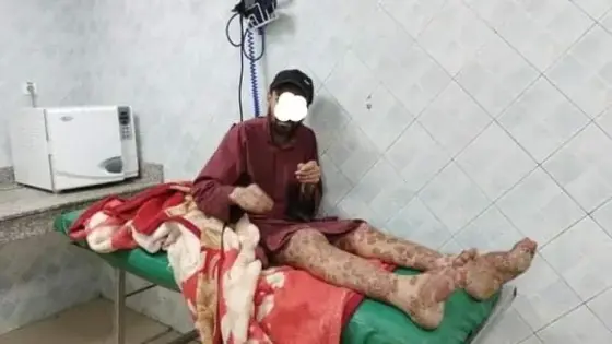 مرض ناذر حير الأطباء يتسبب في تقشُّر ساقي شاب ضواحي إنزكان