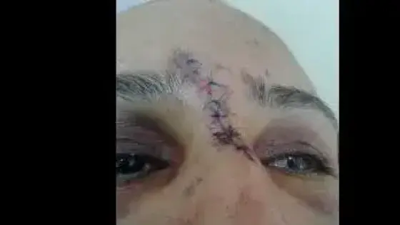 المصالح الأمنية بالبيضاء تتفاعل مع صورة السيدة ضحية اعتداء “شنيع” على مستوى الأنف
