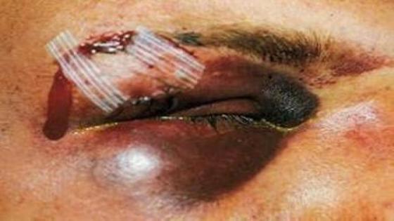 جناة يفقأون عين شخص بدافع السرقة في تزنيت