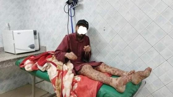 مرض ناذر حير الأطباء يتسبب في تقشُّر ساقي شاب ضواحي إنزكان